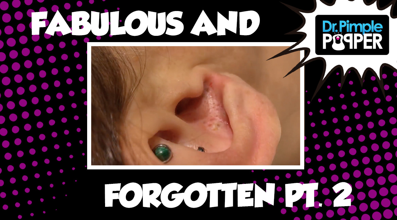Blackheads: The Fabulous & Forgotten, Part Two (Ft. Pimple Pete!)