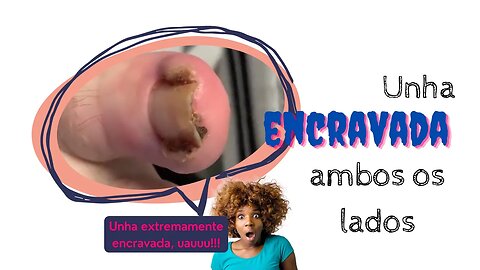 Remoção profissional de unha encravada #unhaencravada #podologia #nails #ingrown_toenail