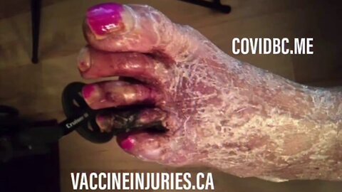 Vaxx-Induced Amputation 💉