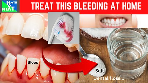 HOW TO TREAT GUM BLEEDING