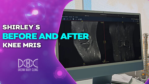 Shirleys Before and After Knee MRIs - Huge Improvement to Arthritis ACL and Meniscus from Stem Cells