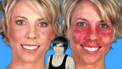 Acne Makeup Cover Up (Before and After)