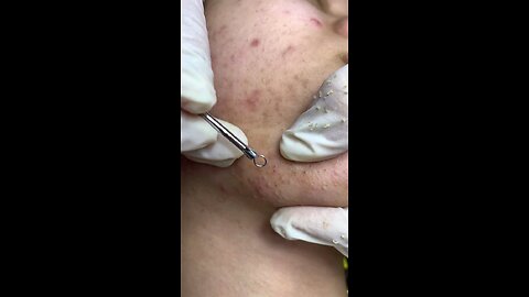 Blackheads episode 63