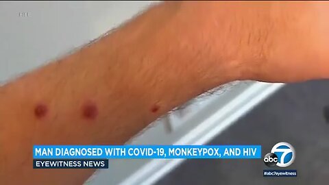 The first person ever diagnosed with COVID-Monkey-AIDS-Pox
