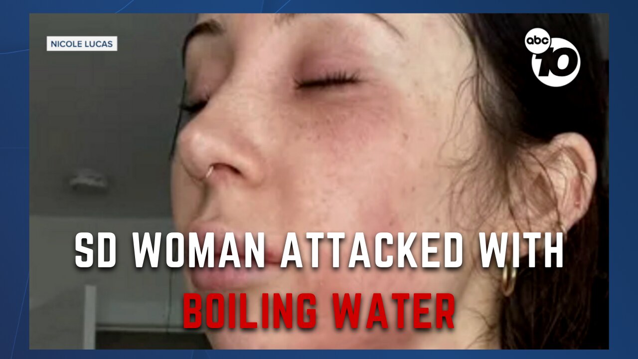 San Diego native burned in boiling water attack