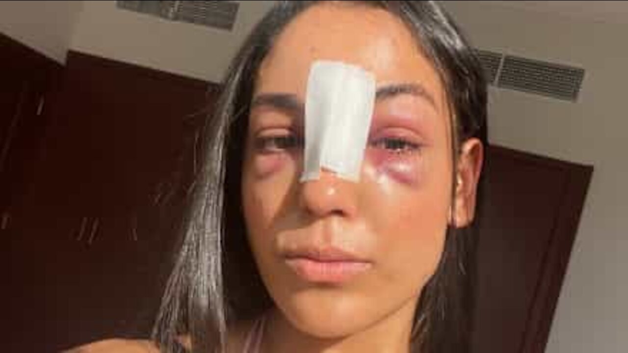 Exercício com elástico acaba em acidente assustador