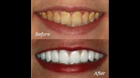 TEETH WHITENING in Five minutes at home
