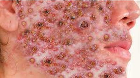Acne Blackheads ll acne blackheads face wash