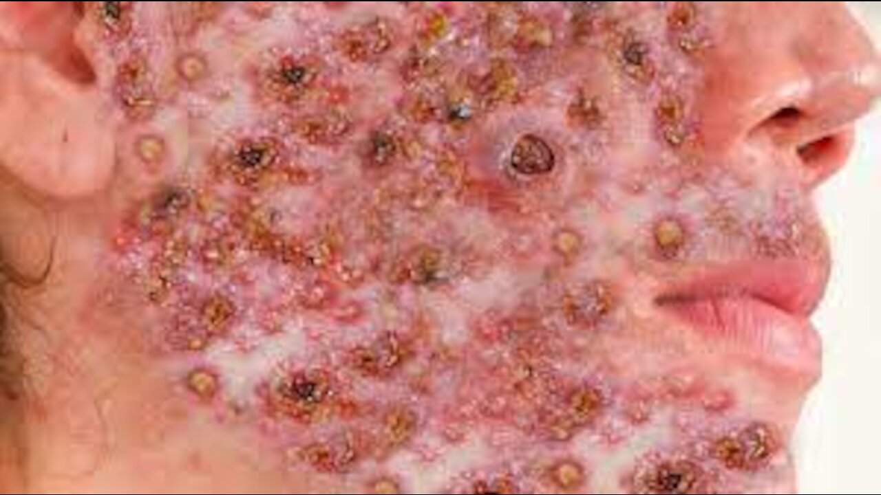 Acne Blackheads ll acne blackheads face wash