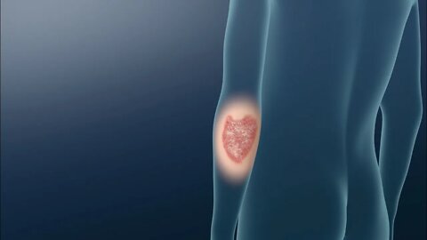 Qué es la psoriasis