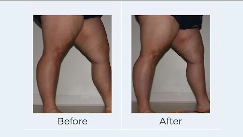 Get Rid of Varicose Veins // American Vein & Vascular