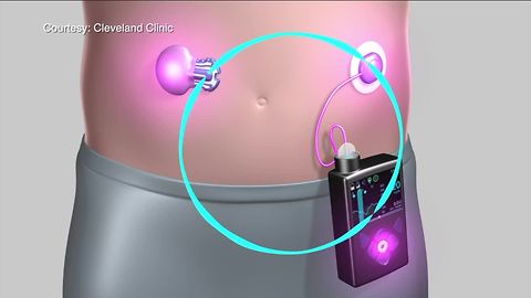 Artificial pancreas for diabetes treatment tops Cleveland Clinic's 2018 top 10 medical innovations