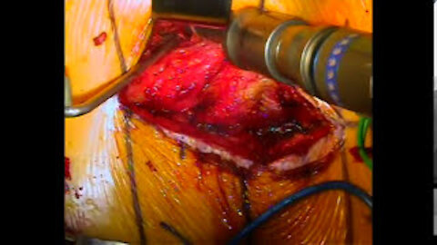 Transforaminal lumbar interbody fusion (TLIF) by Edwin Haronian MD
