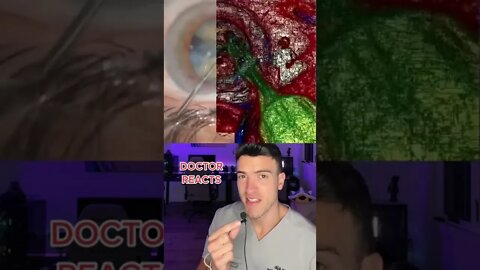 This Is What Cataract Surgery Looks Like!