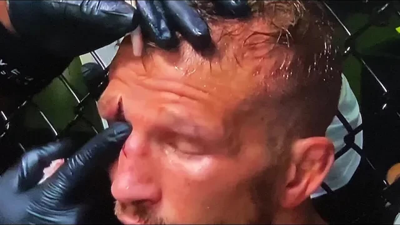 Cut man pokes TJ Dillashaw in his eye hole