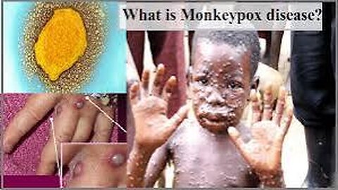 Monkeypox Virus Outbreak: Cases of Monkeypox⚠️⚠️⚠️