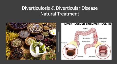Diverticulosis & Diverticular Disease Natural Treatment