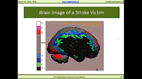 Brain Image of A Stroke Victim who died from Injuries - Byron Hyde, MD