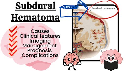 Subdural Hemorrhage (SDH) Explained: Causes, Symptoms, Diagnosis, and Treatment | Novice Medic"