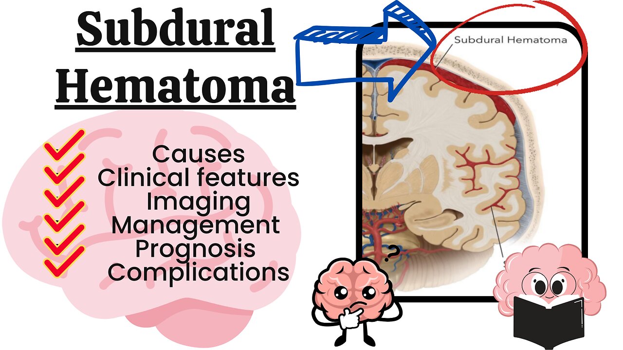 Subdural Hemorrhage (SDH) Explained: Causes, Symptoms, Diagnosis, and Treatment | Novice Medic"