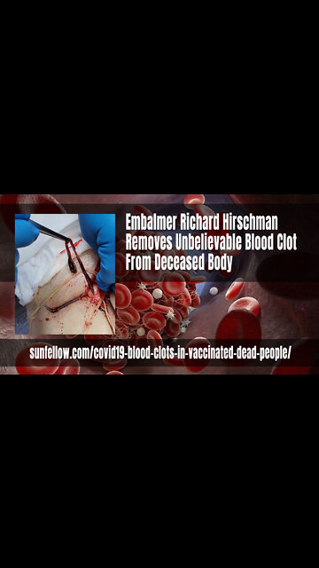 Embalmer Richard Hirschman Removes Unbelievable Blood Clot From Deceased Body