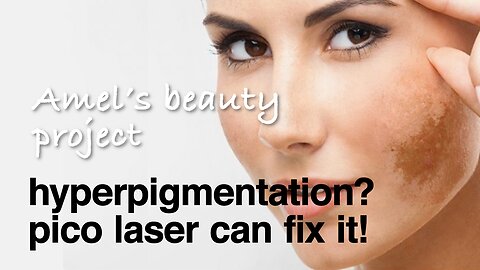 🤩 Hyperpigmentation Woes? | TRANSFORM Your SKIN With a Pico Laser Treatment