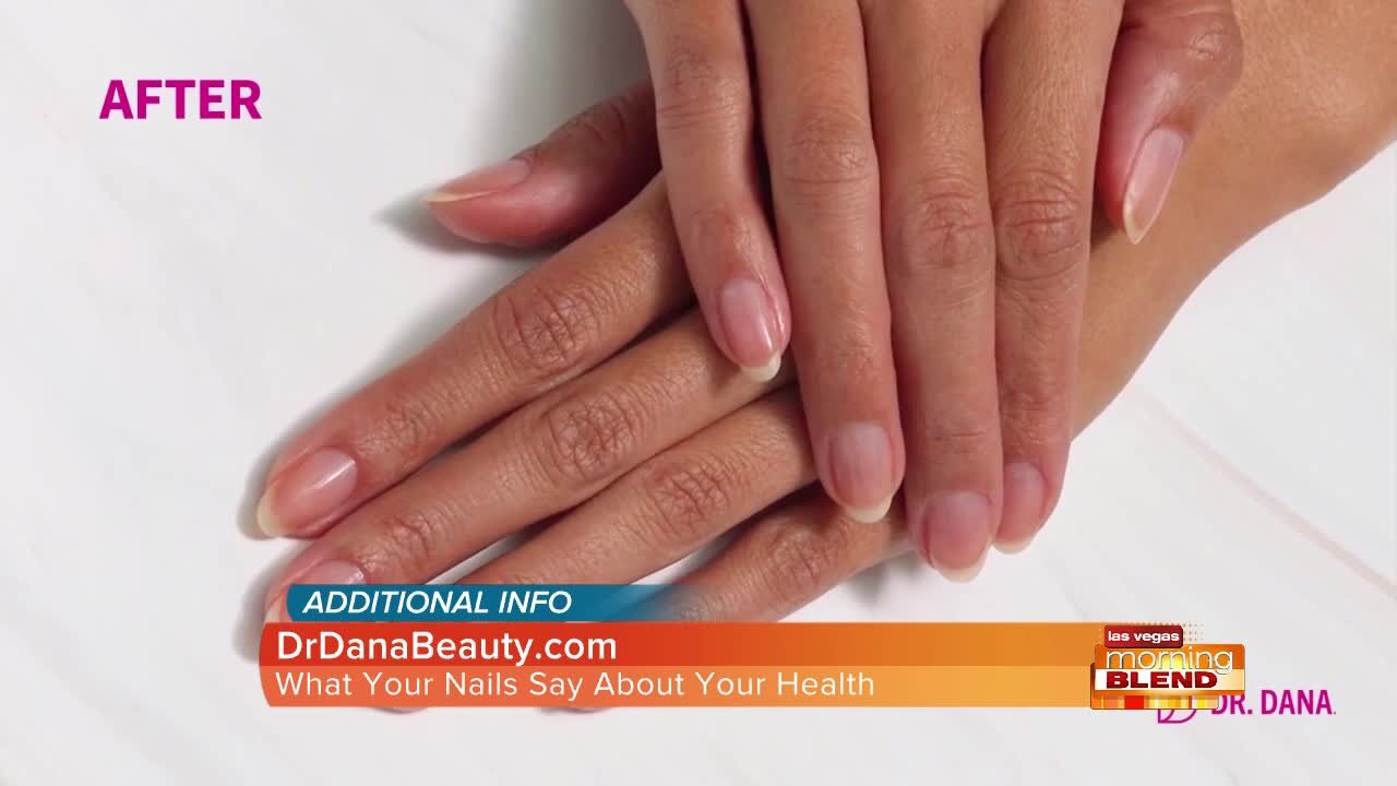 What Your Fingernails Can Tell You About Your Health