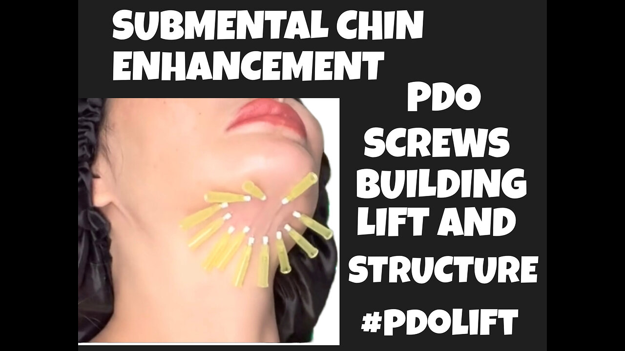 Submental Chin Neck Tightening Using Mono
