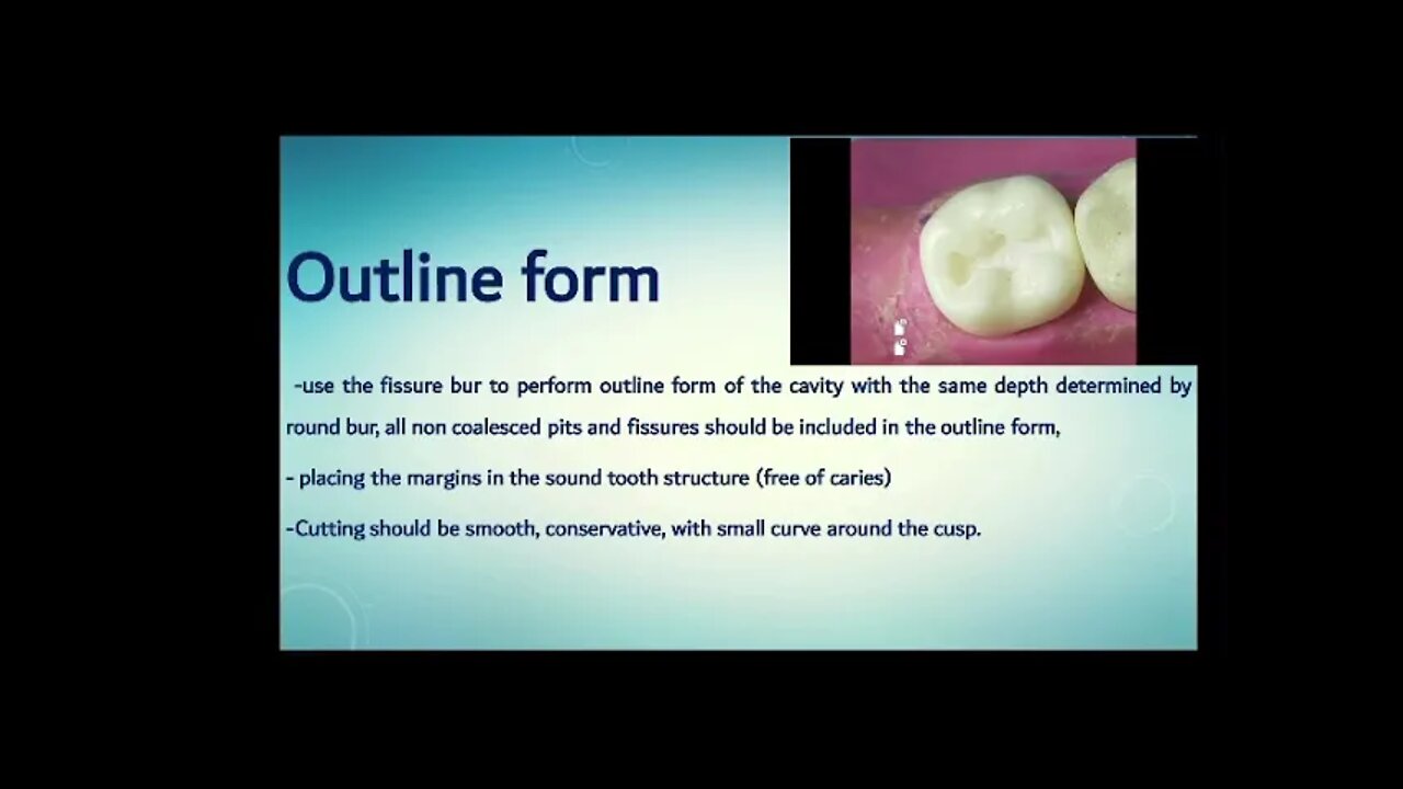 Operative L3 (Class I cavity preparation)