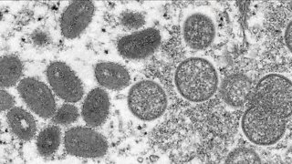 Monkeypox cases surpass 1,300 in FL, officials work to administer more vaccines