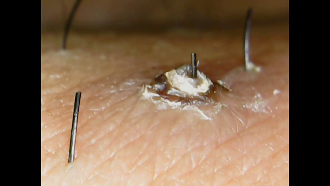 Best Pimple popping video of 2019, You won't find it on Dr. Pimple popper