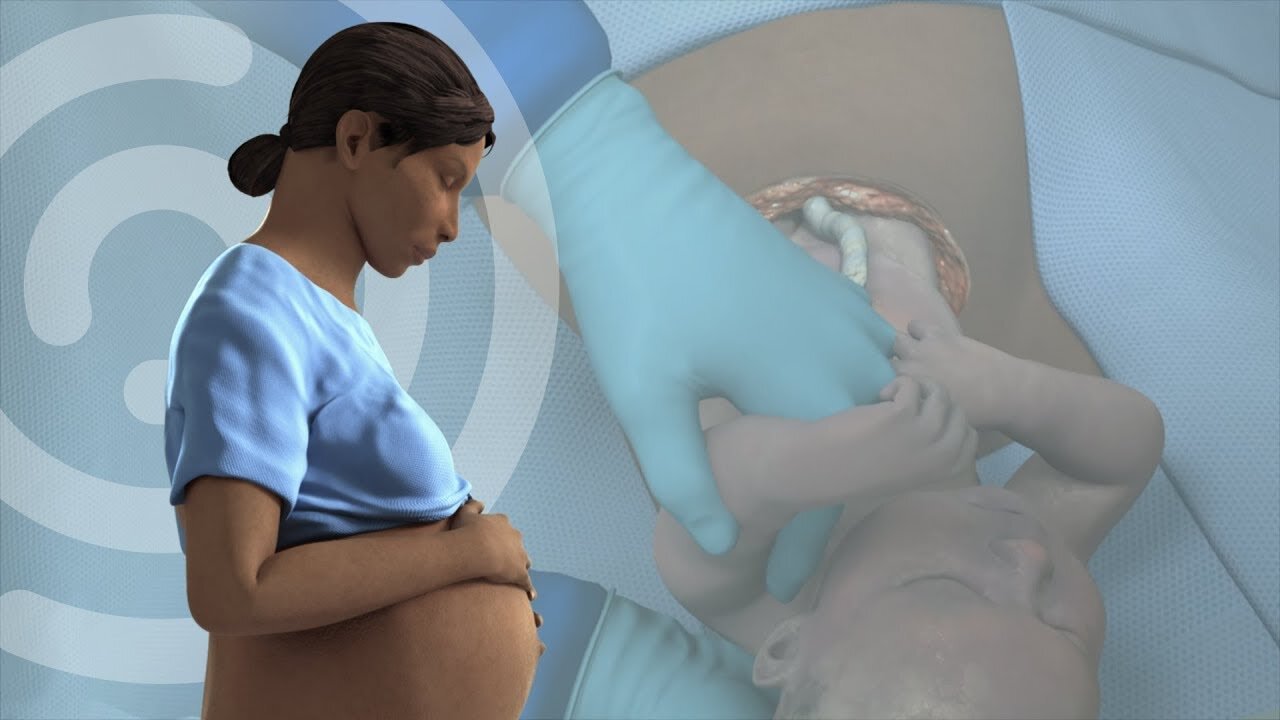 Touch Surgery Simulation - Cesarean Section (Patient information video)