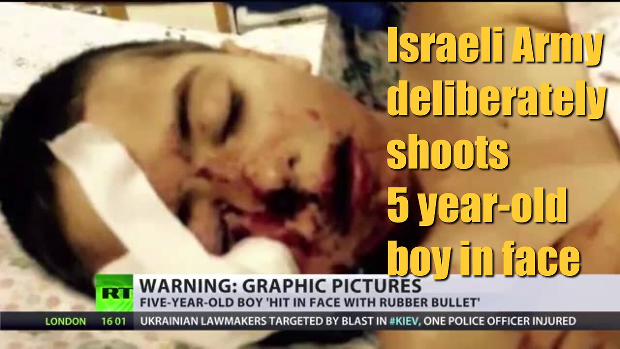 Israeli Army deliberately shoots 5 year old boy in face