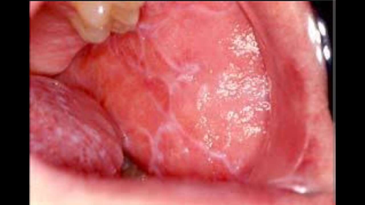 Oral lichen planus