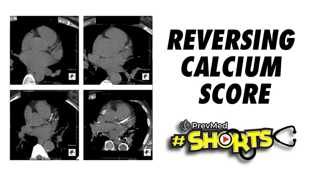 #SHORTS Reversing Calcium Score