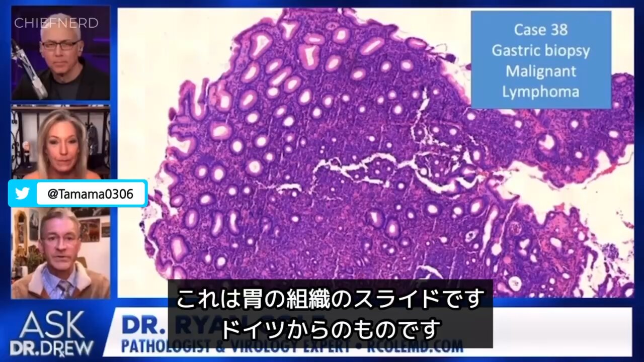 【コロワク】癌細胞にスパイクタンパク質