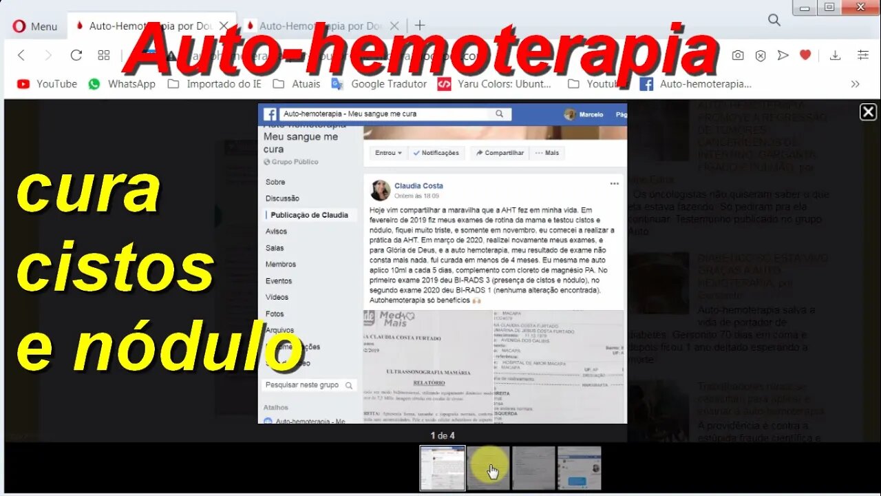 Auto-hemoterapia cura cistos e nódulo em menos de 4 meses.