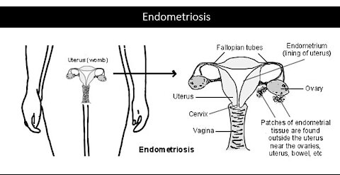 Endometriosis - Natural Treatment