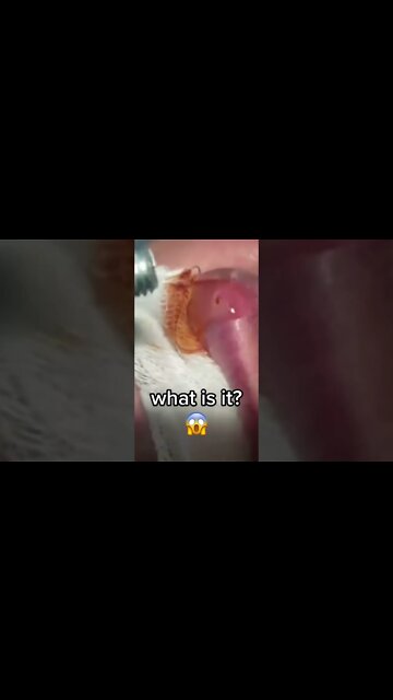 Worm Extraction under Skin (I think 🤔) - blackheads removal