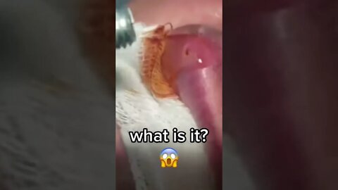 Worm Extraction under Skin (I think 🤔) - blackheads removal