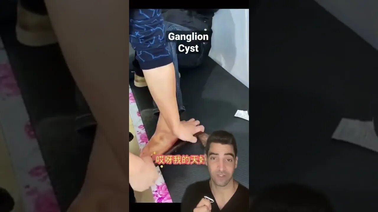 Ganglion Cyst