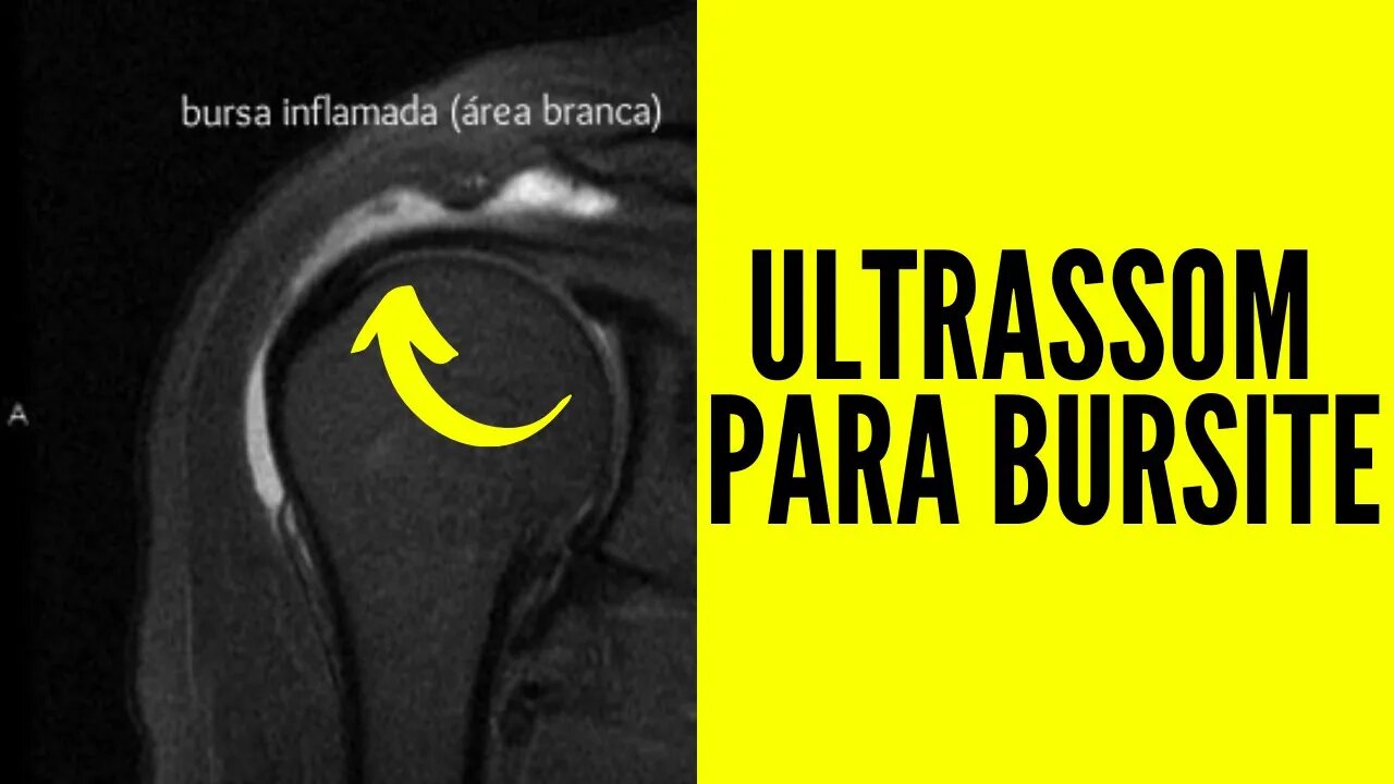 Bursite - Ultrassom Para Bursite