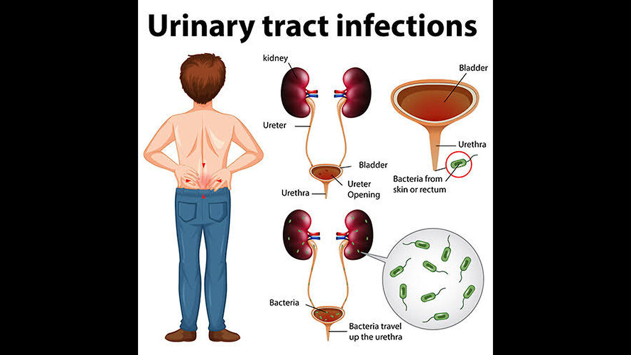 Urinary tract infections full treatment in medical