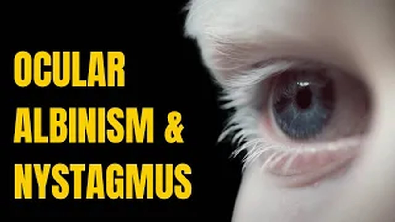Success Treating Ocular Albinism Related Nystagmus, & Poor Eyesight
