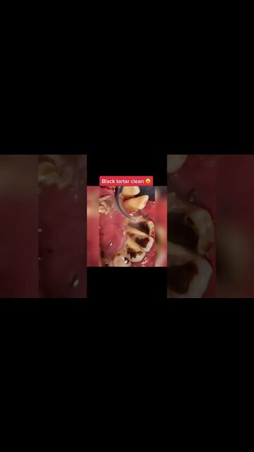 Black tartar removal from teeth #satisfying