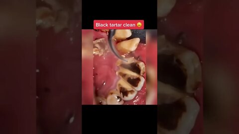 Black tartar removal from teeth #satisfying