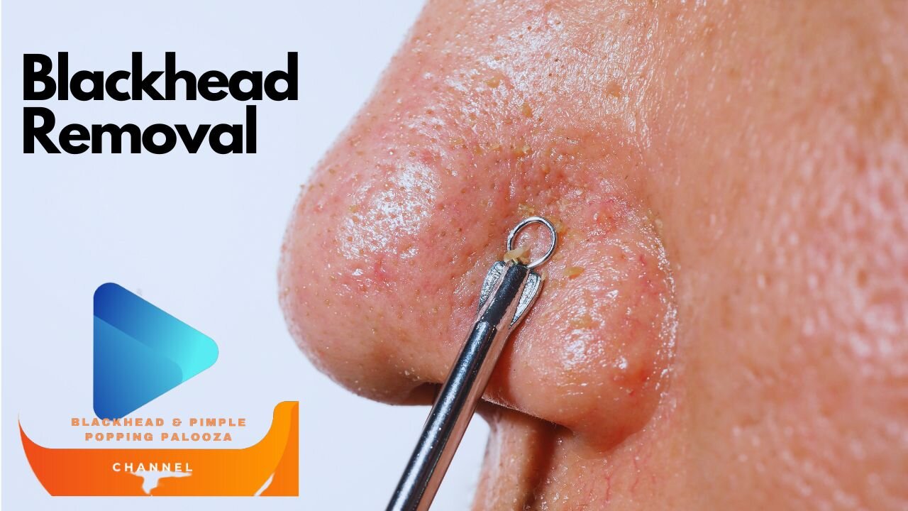 Blackhead Removal Video