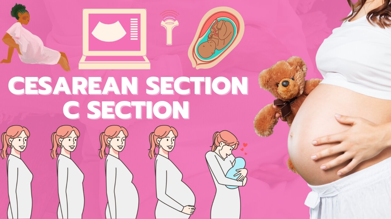 C-section animation | Cesarean section | Baby delivery animation