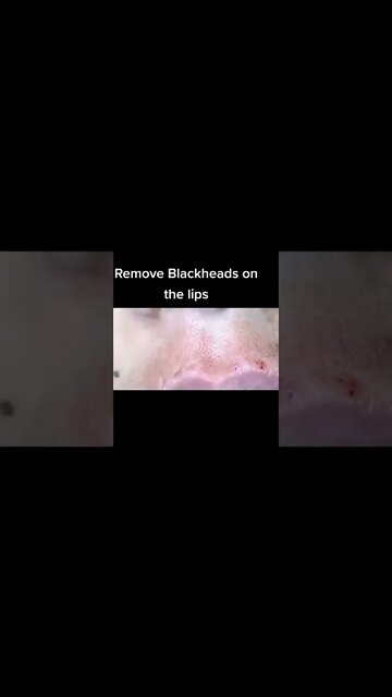 Remove Blackheads around the Lips 💋