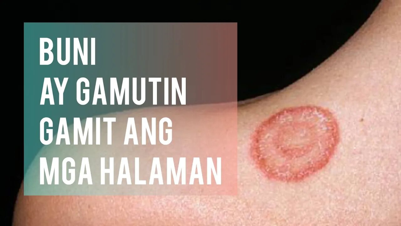 HALAMANG GAMOT PARA SA BUNI